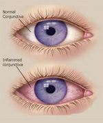 What is Diabetic Retinopathy?