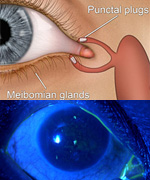 Flashers and Floaters